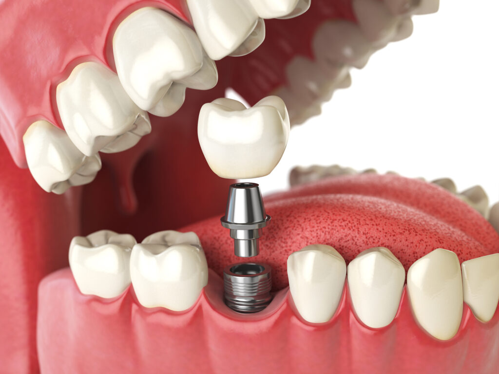 difference-between-implant-supported-crown-and-abutment-crown