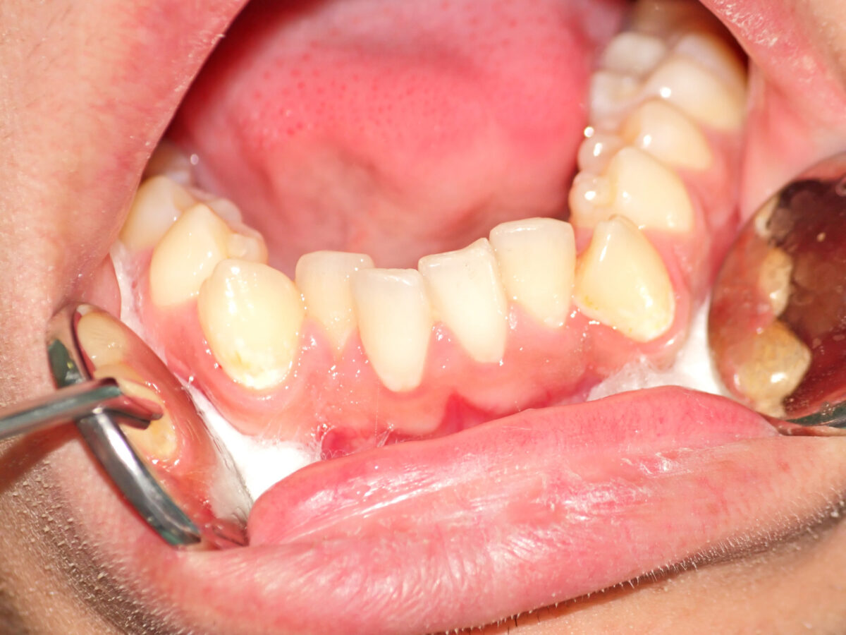 What Is A Bicuspid In Relation To Dental Health 