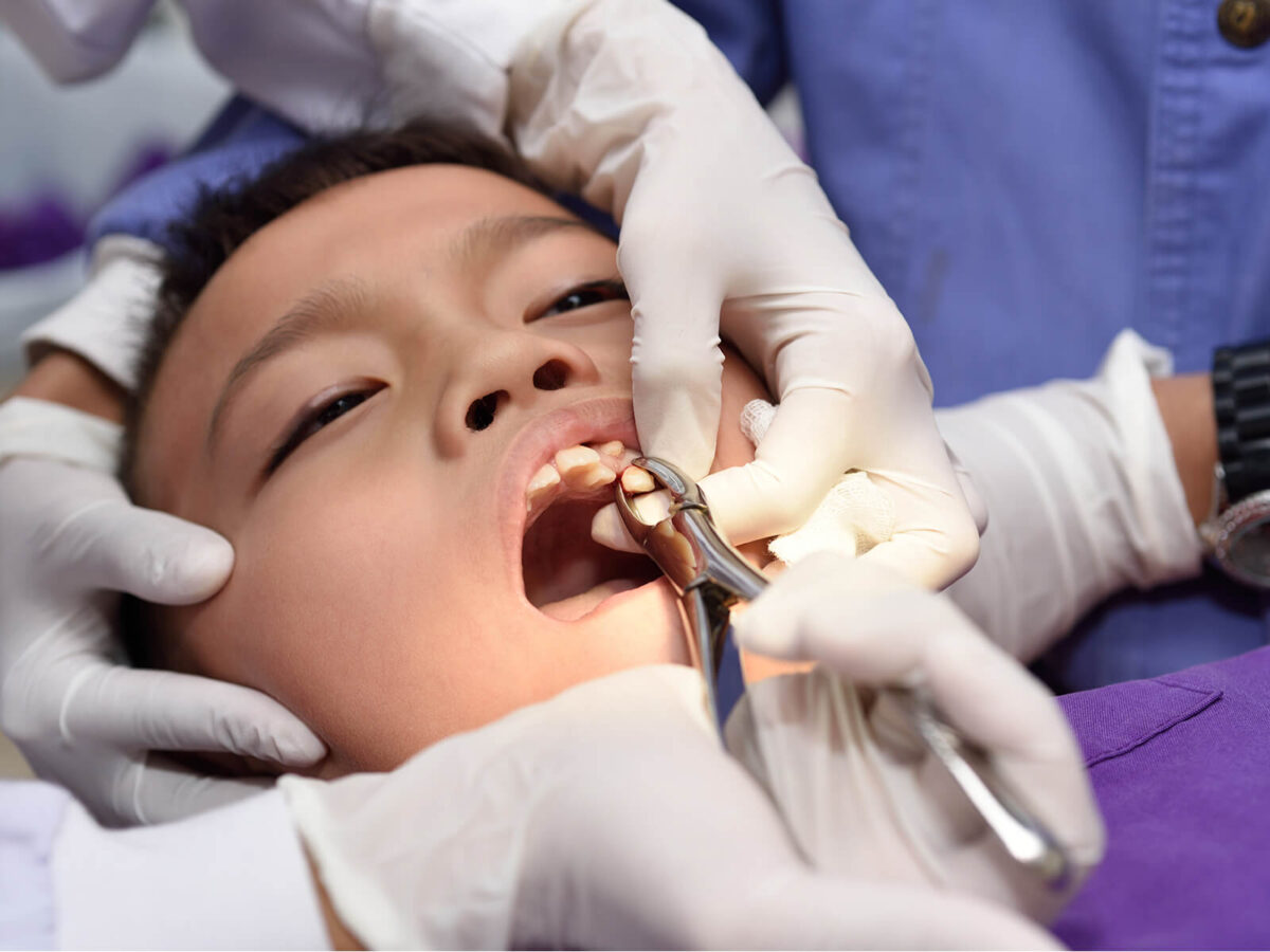 Tooth Extractions