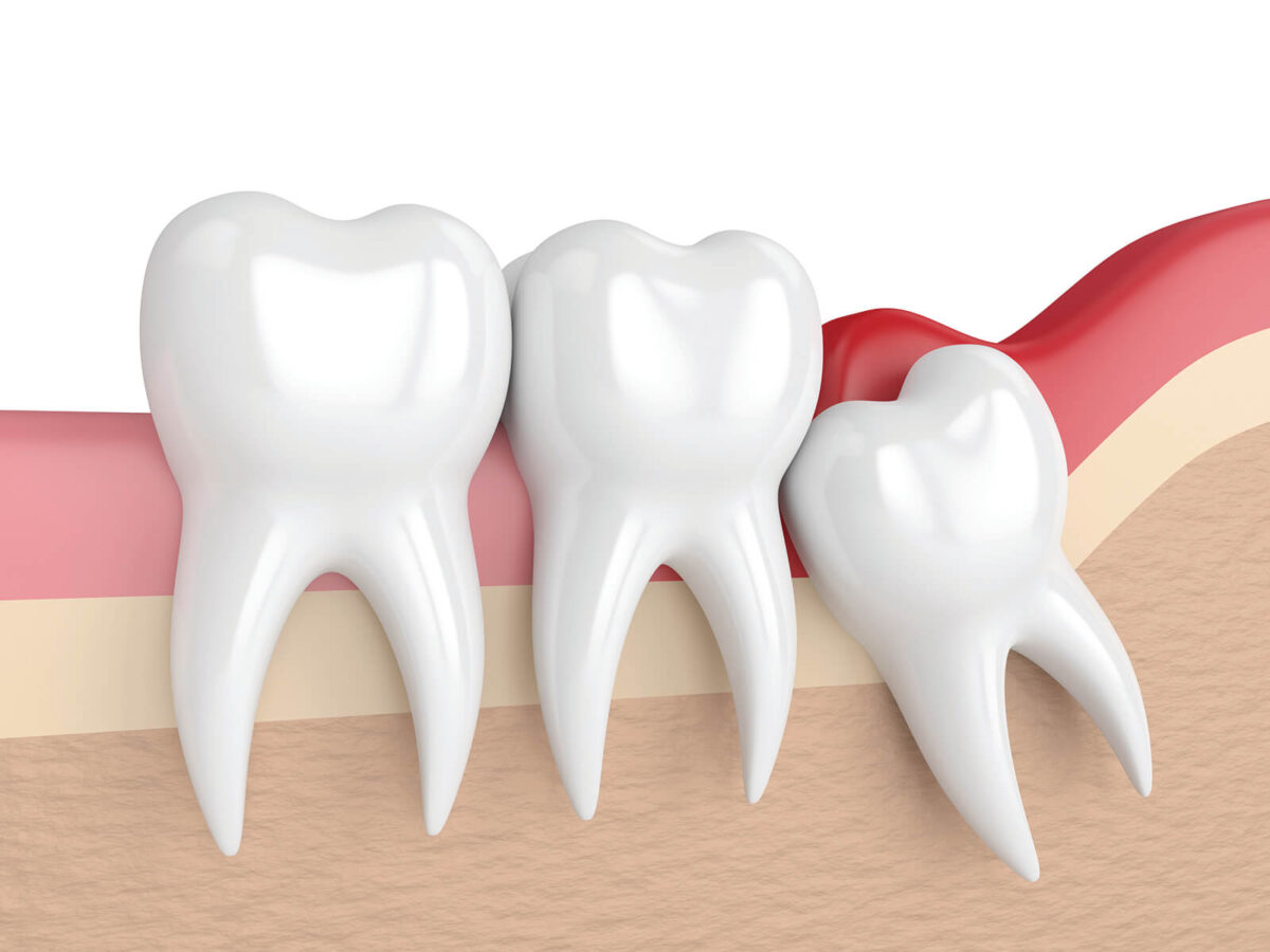 Four Facts You May Not Know About Wisdom Teeth