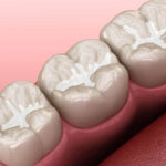 Can I brush My Teeth After sealants?