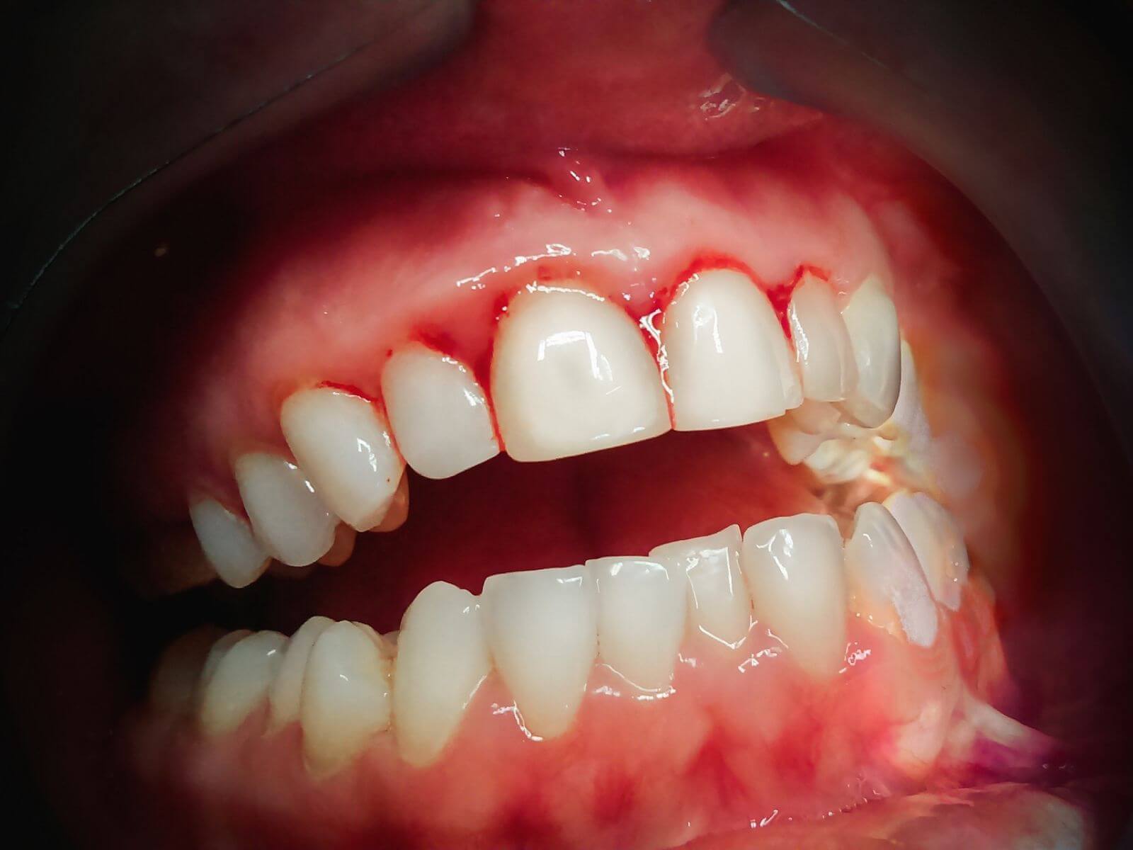 Treatment Options For Receding Gums: What You Need To Know