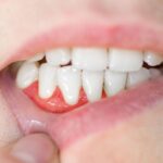 How Early Detection of Gum Disease Saves Teeth And Lowers Treatment Costs